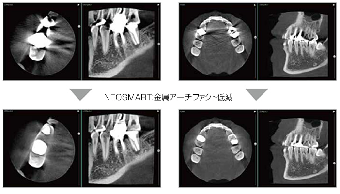 NEOSMART：金属アーチファクト低減