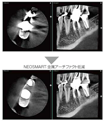 NEOSMART：金属アーチファクト低減 その１