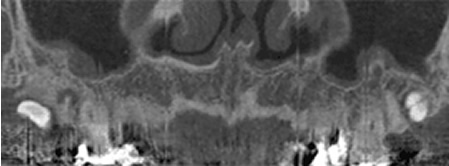埋伏智歯CT診断　例その２