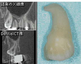 埋伏智歯CT診断症例　その２