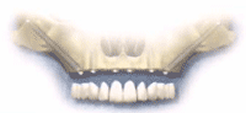 ザイゴマインプラント(zygomaticum implant）