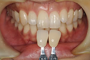 歯石除去と写真撮影