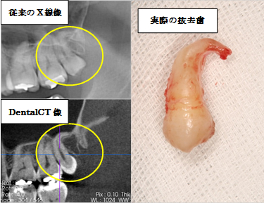 親知らず 抜歯 膿