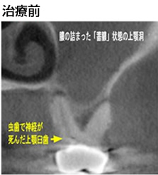 上顎洞炎治療前の画像