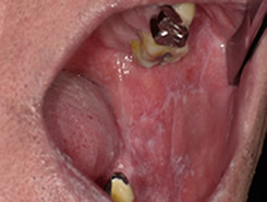 口腔扁平苔癬の症例