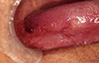 舌がんの症例　その２