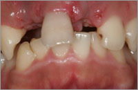 前歯部の2歯欠損
