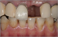 前歯部の１歯欠損