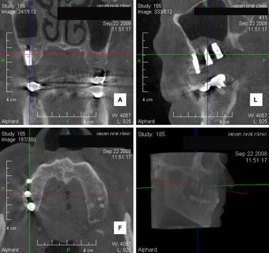 上顎奥歯の３歯欠損症例　顎の骨がなく上顎洞に骨を移植して（＝サイナスリフト）インプラントを埋入